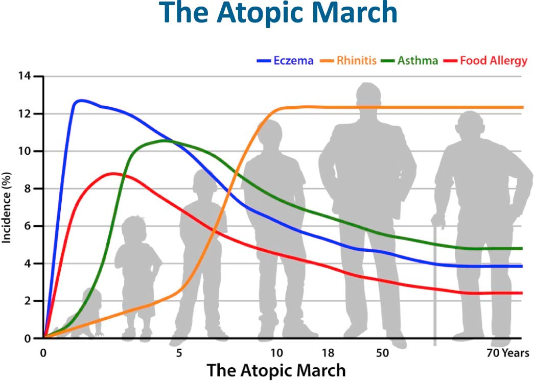 Early Signs of Food Allergies: The Atopic March