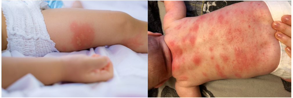 Eczema Flare vs Allergic Reaction