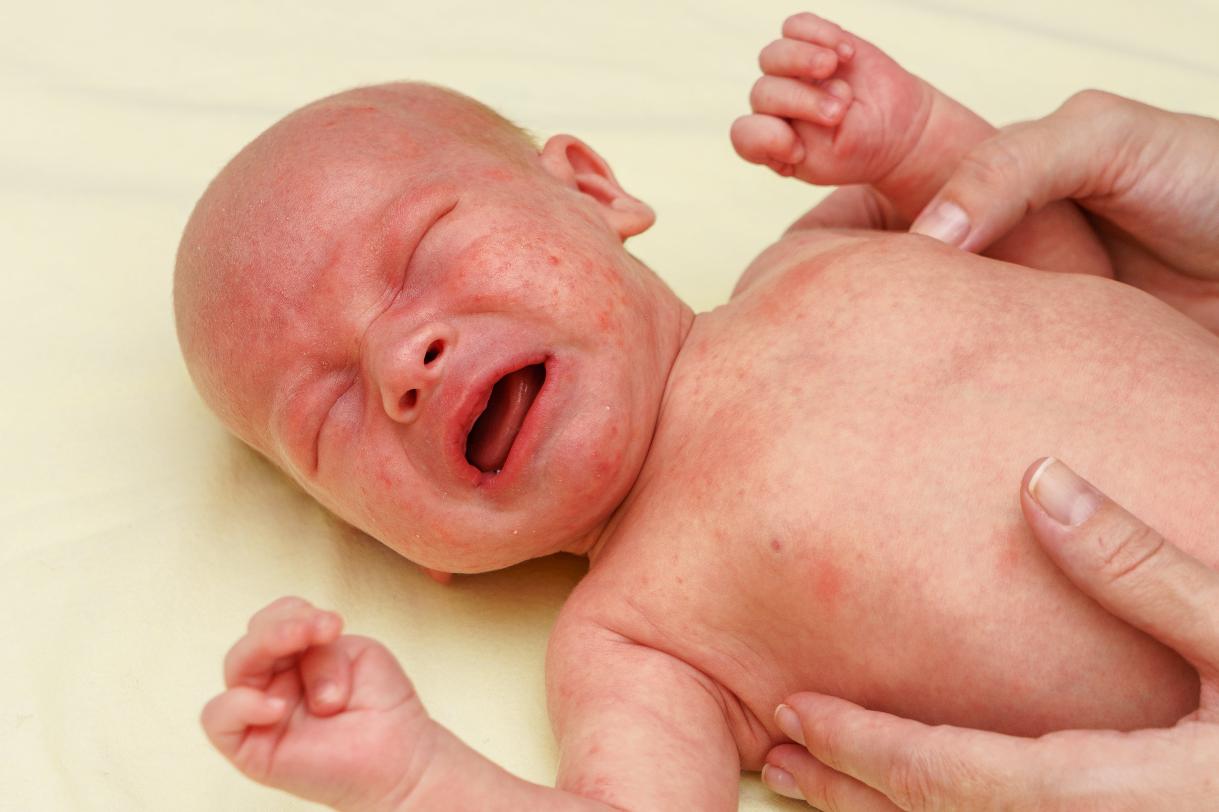 Measuring Eczema Severity on a Baby