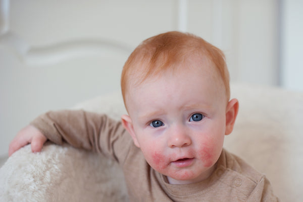 The Causes of Eczema in Infants